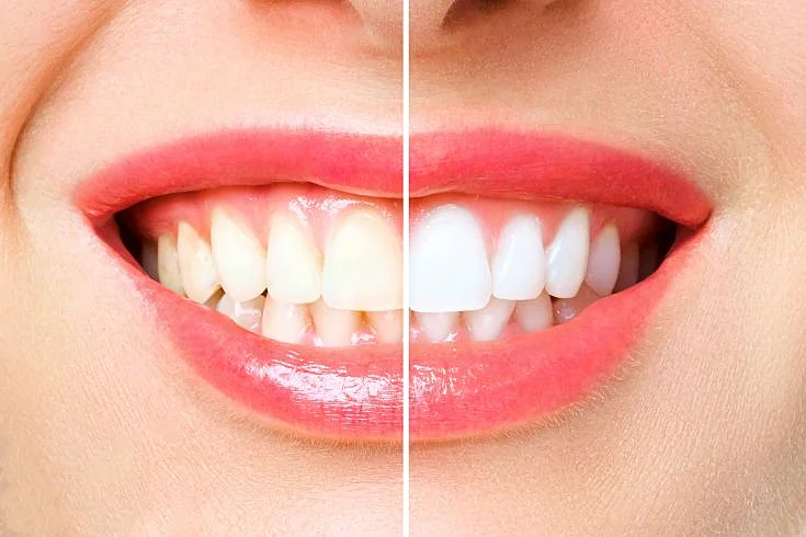 teeth whitening in leicester