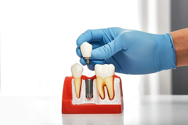 dental implants leicester